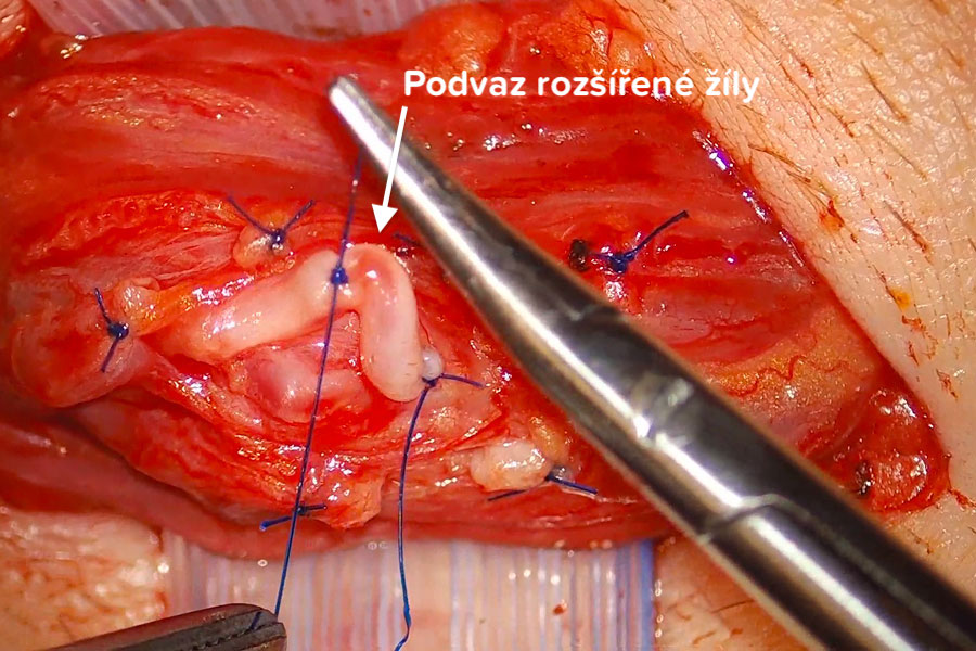 Varikokéla operace- Podvaz rozšířené žíly