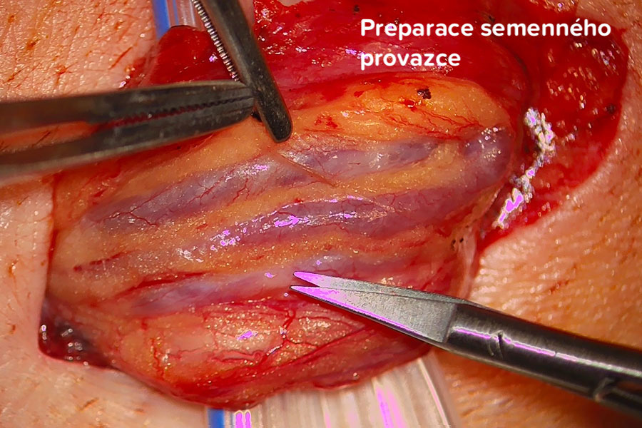 Varikokéla operace- Preparace semenného provazce