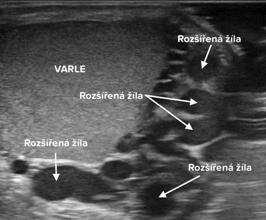 Sonografický obraz varlete se zmnoženou žilní pletení