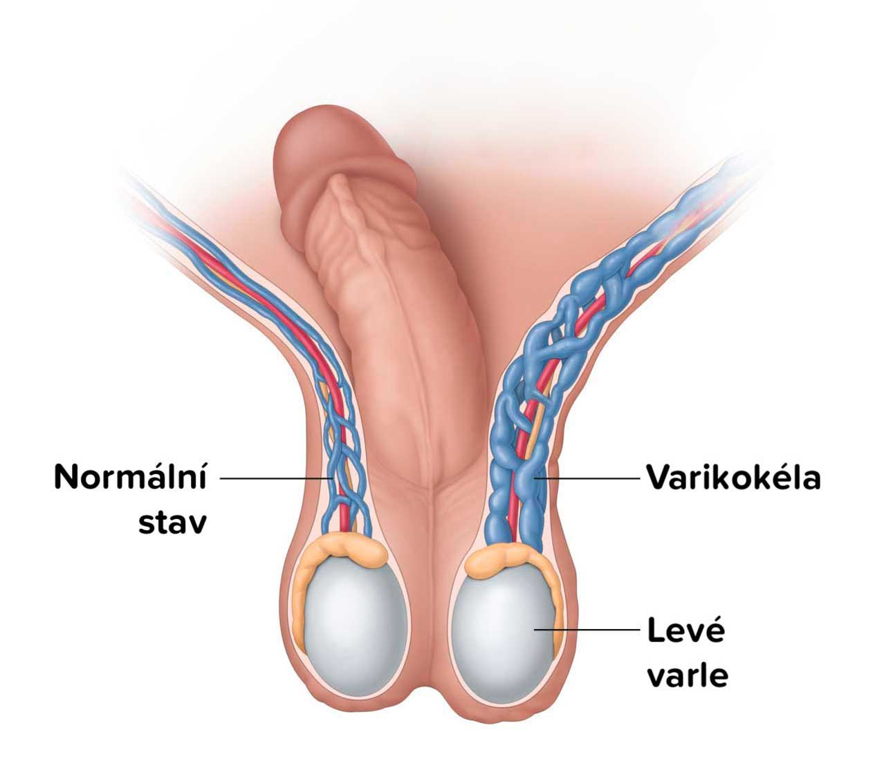 Varikokéla