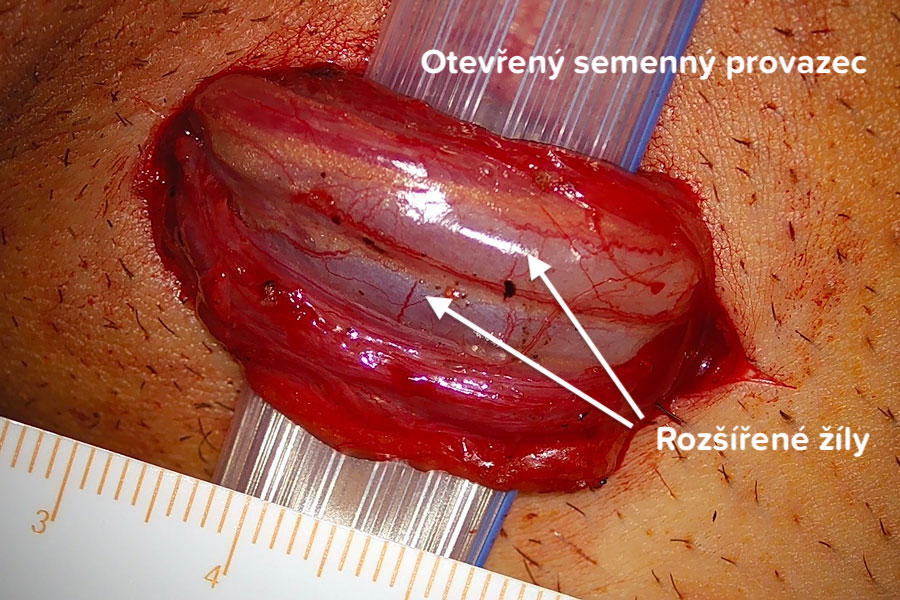 Varikokéla operace- Vypreparované žíly semenného provazce